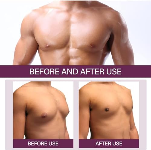 gynecomastia reduction spray