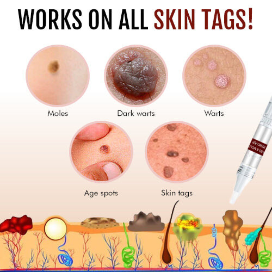 Tags & Moles Remover (Buy 1 Get 1 Free)